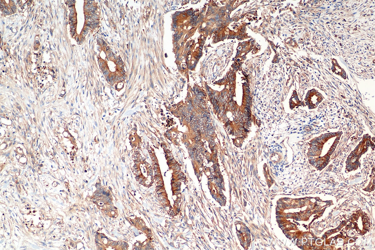 Immunohistochemical analysis of paraffin-embedded human rectal cancer tissue slide using 85449-5-RR (RIOK3 antibody) at dilution of 1:2000 (under 10x lens). Heat mediated antigen retrieval with Tris-EDTA buffer (pH 9.0). Immunohistochemistry (IHC) staining of human rectal cancer tissue using RIOK3 Recombinant monoclonal antibody (85449-5-RR)