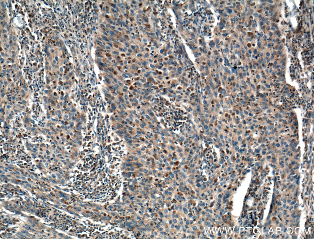 Immunohistochemistry (IHC) staining of human cervical cancer tissue using RIPK4 Polyclonal antibody (26458-1-AP)