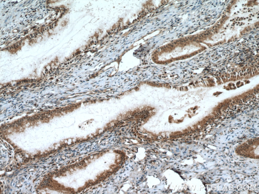 IHC staining of human cervical cancer using 17559-1-AP