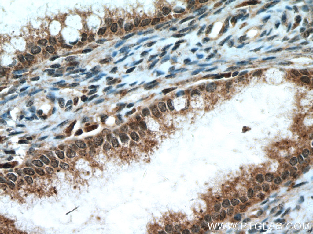 Immunohistochemistry (IHC) staining of human cervical cancer tissue using RMND5A Polyclonal antibody (17559-1-AP)