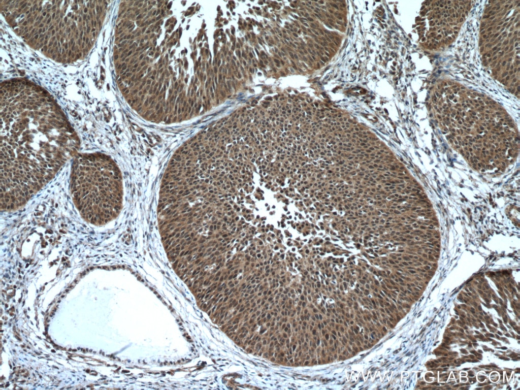 Immunohistochemistry (IHC) staining of human cervical cancer tissue using RMND5A Polyclonal antibody (17559-1-AP)