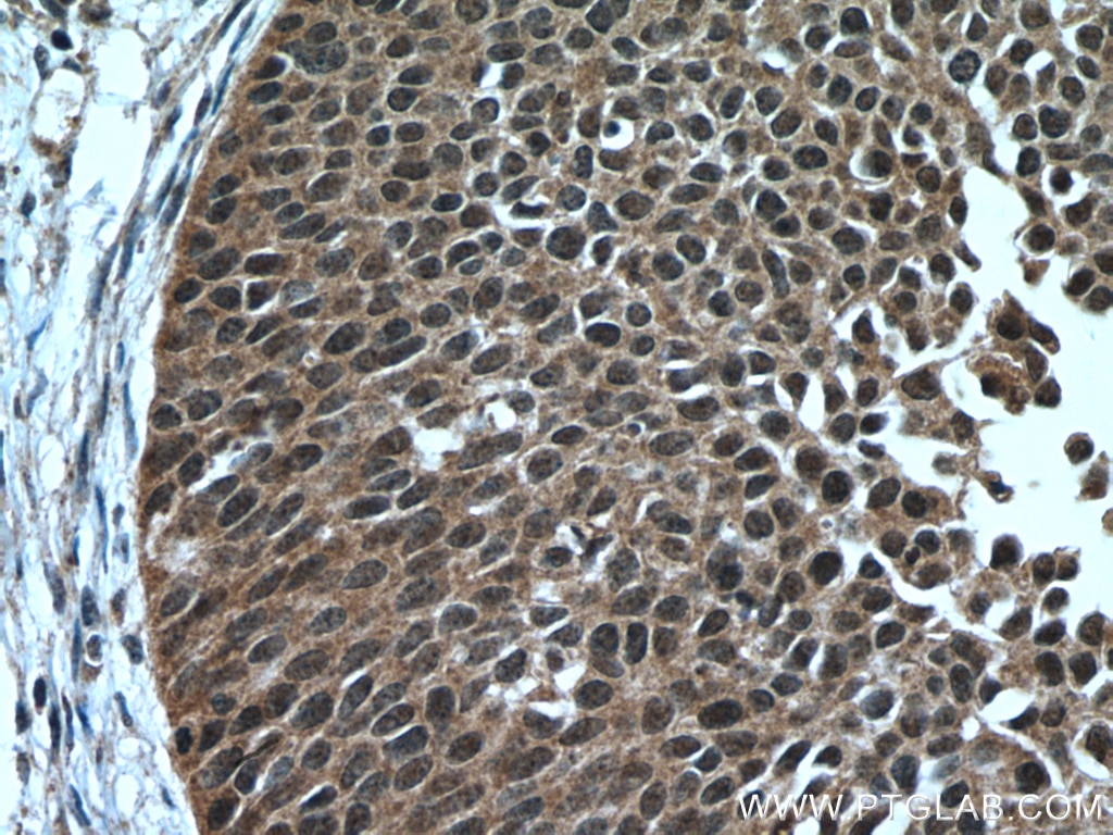 Immunohistochemistry (IHC) staining of human cervical cancer tissue using RMND5A Polyclonal antibody (17559-1-AP)