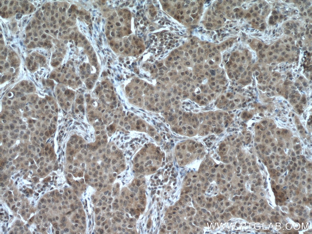 Immunohistochemistry (IHC) staining of human breast cancer tissue using RMND5A Polyclonal antibody (17559-1-AP)