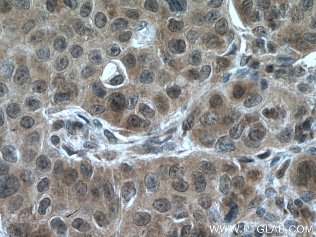 Immunohistochemistry (IHC) staining of human breast cancer tissue using RMND5A Polyclonal antibody (17559-1-AP)