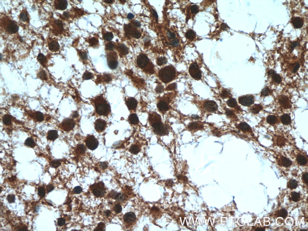 Immunohistochemistry (IHC) staining of human gliomas tissue using RMND5B Polyclonal antibody (25803-1-AP)