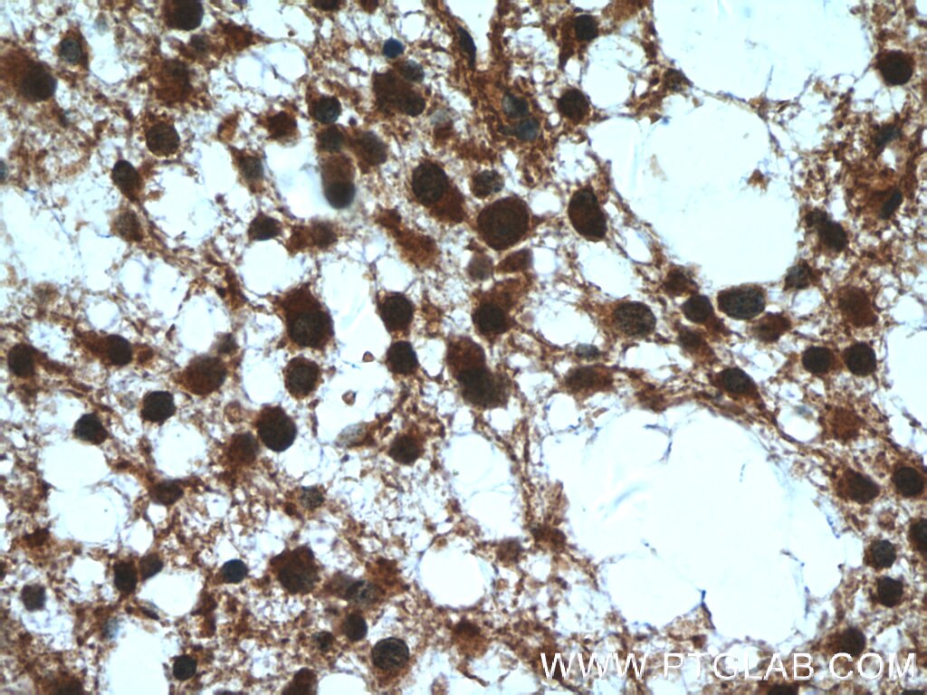 Immunohistochemistry (IHC) staining of human gliomas tissue using RMND5B Polyclonal antibody (25803-1-AP)
