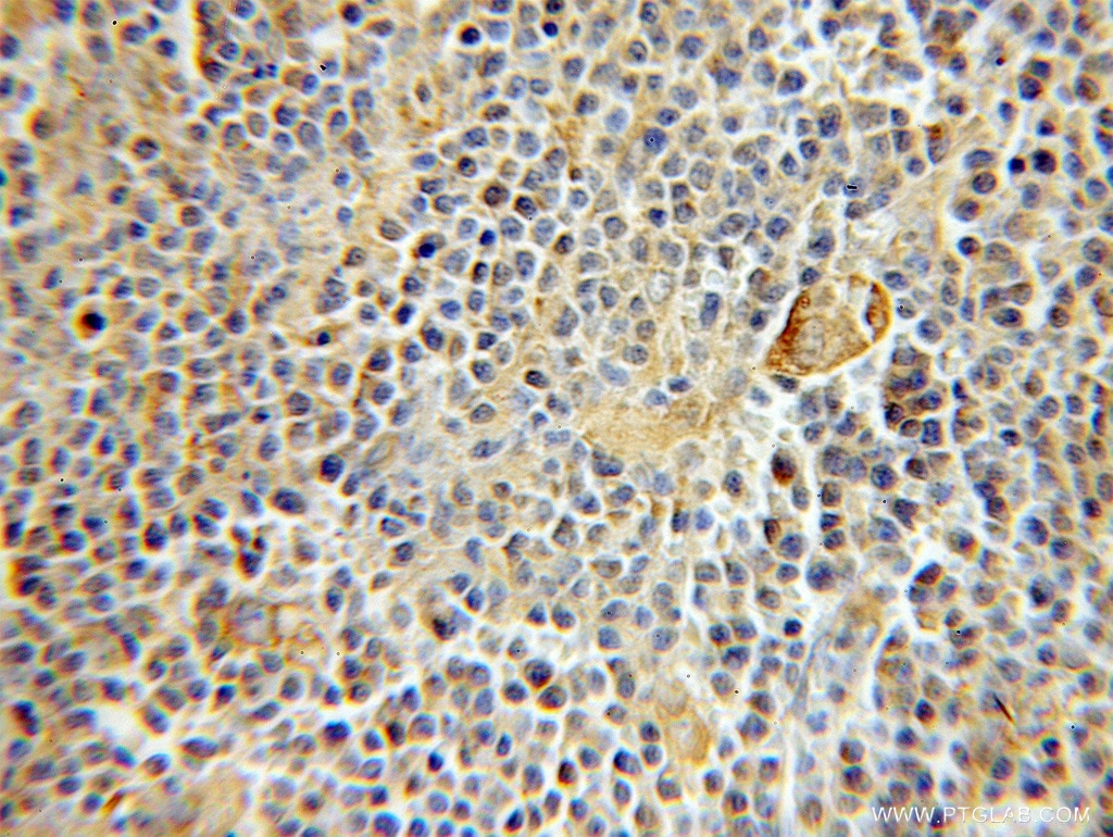 Immunohistochemistry (IHC) staining of human lymphoma tissue using RMP Polyclonal antibody (11277-1-AP)