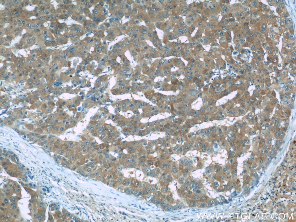 Immunohistochemistry (IHC) staining of human liver cancer tissue using RMP Polyclonal antibody (11277-1-AP)