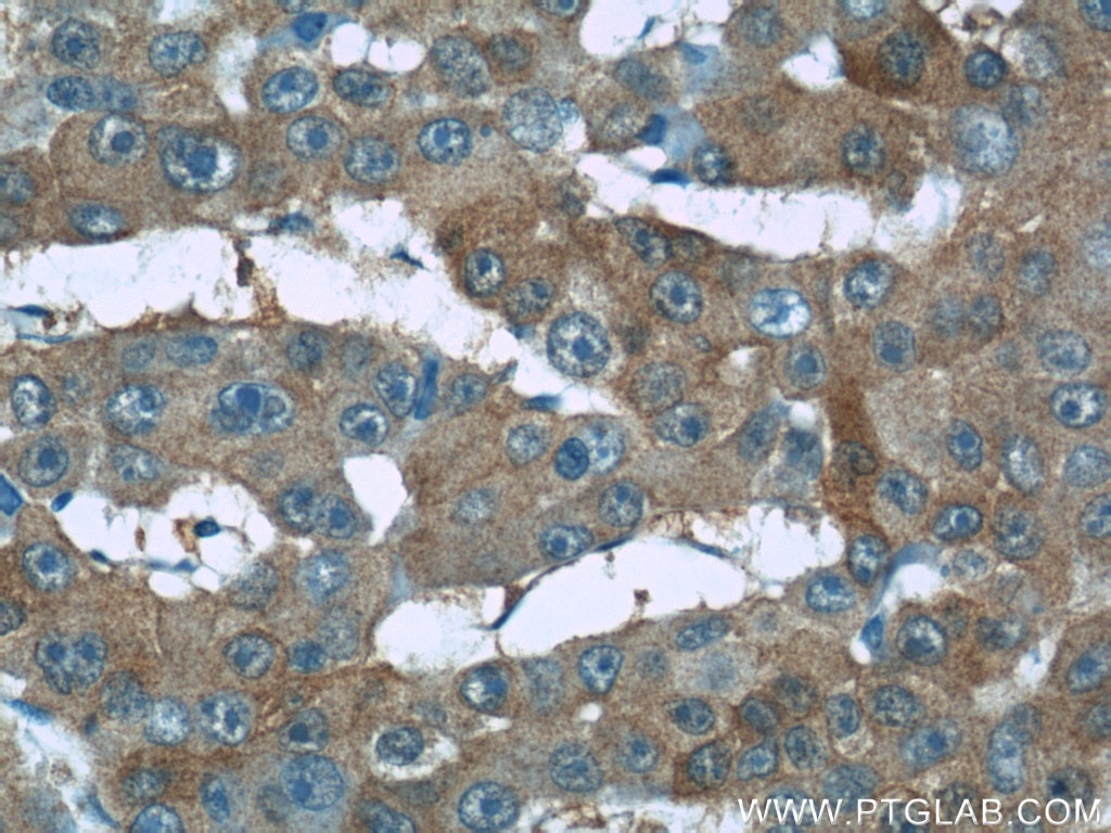 Immunohistochemistry (IHC) staining of human liver cancer tissue using RMP Polyclonal antibody (11277-1-AP)