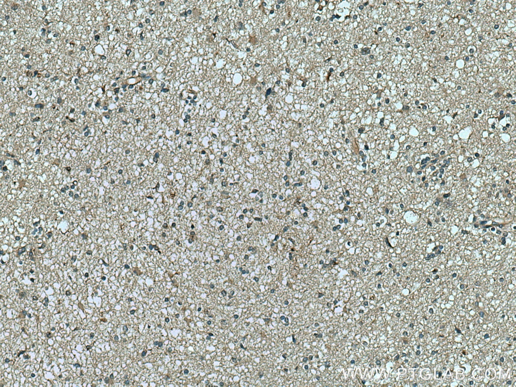 Immunohistochemistry (IHC) staining of human gliomas tissue using RNASE11 Polyclonal antibody (17203-1-AP)