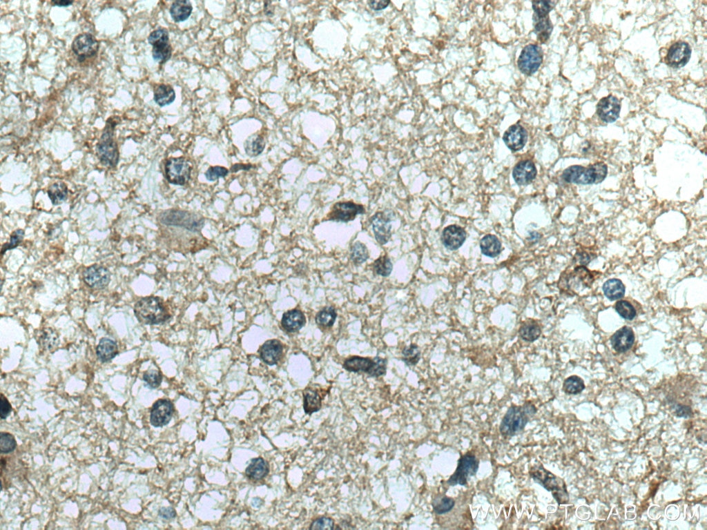Immunohistochemistry (IHC) staining of human gliomas tissue using RNASE11 Polyclonal antibody (17203-1-AP)