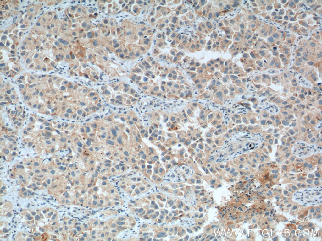 IHC staining of human lung cancer using 55338-1-AP