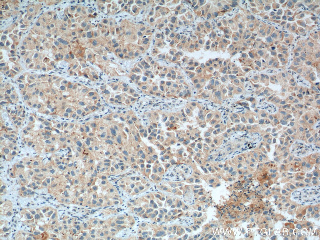 Immunohistochemistry (IHC) staining of human lung cancer tissue using RNASE3 Polyclonal antibody (55338-1-AP)