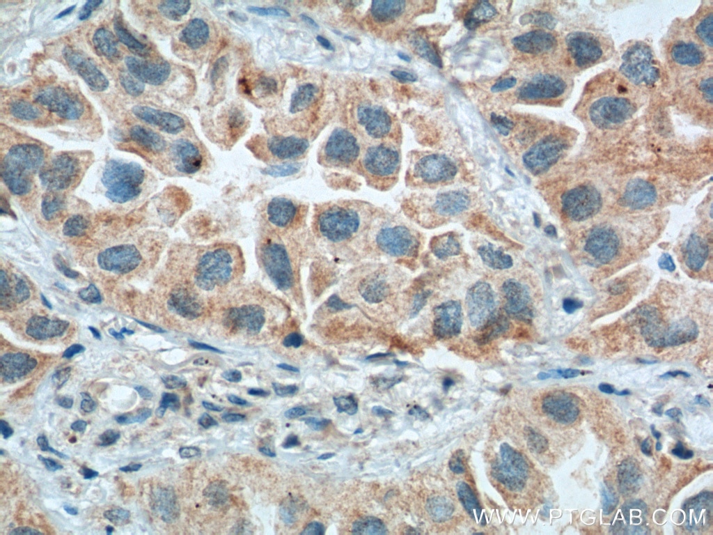 Immunohistochemistry (IHC) staining of human lung cancer tissue using RNASE3 Polyclonal antibody (55338-1-AP)