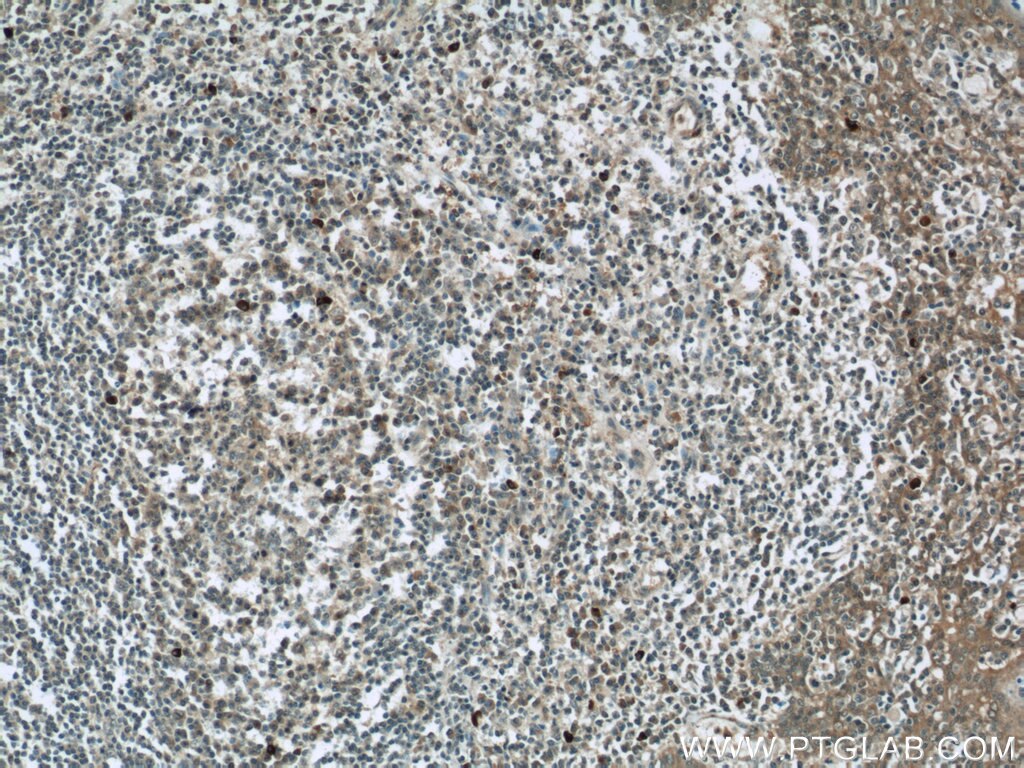 IHC staining of human tonsillitis using 22577-1-AP