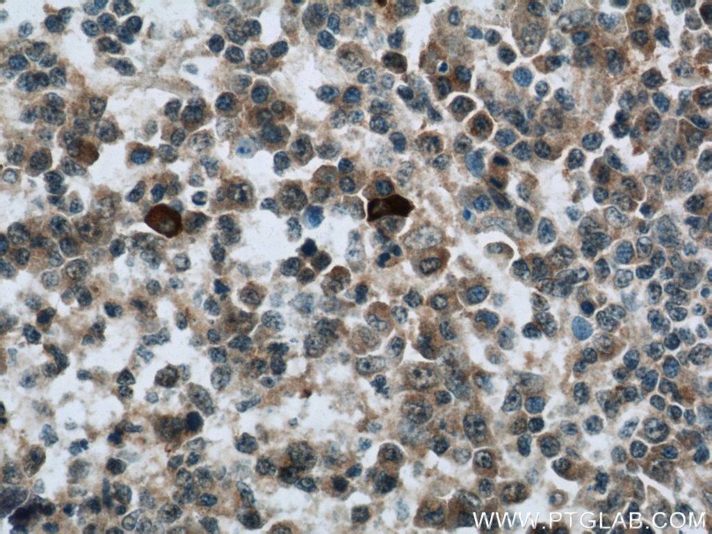 Immunohistochemistry (IHC) staining of human tonsillitis tissue using RNASEL Polyclonal antibody (22577-1-AP)