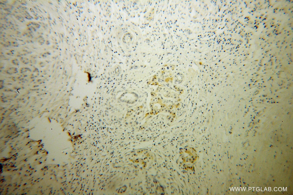 IHC staining of human pancreas cancer using 13753-1-AP