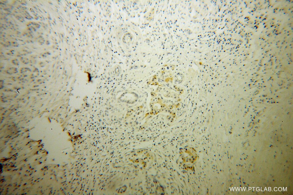 Immunohistochemistry (IHC) staining of human pancreas cancer tissue using RNase T2 Polyclonal antibody (13753-1-AP)