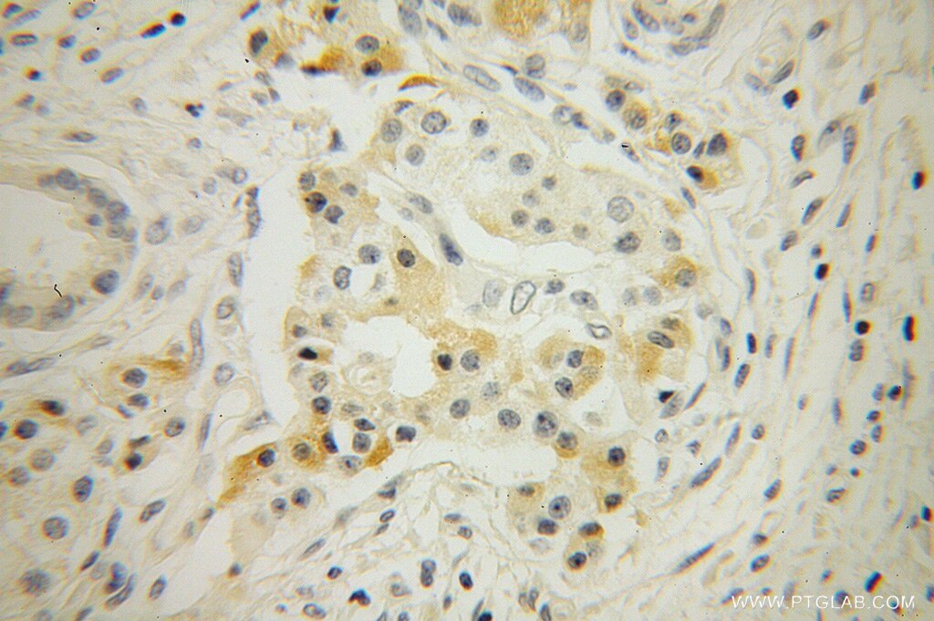 Immunohistochemistry (IHC) staining of human pancreas cancer tissue using RNase T2 Polyclonal antibody (13753-1-AP)