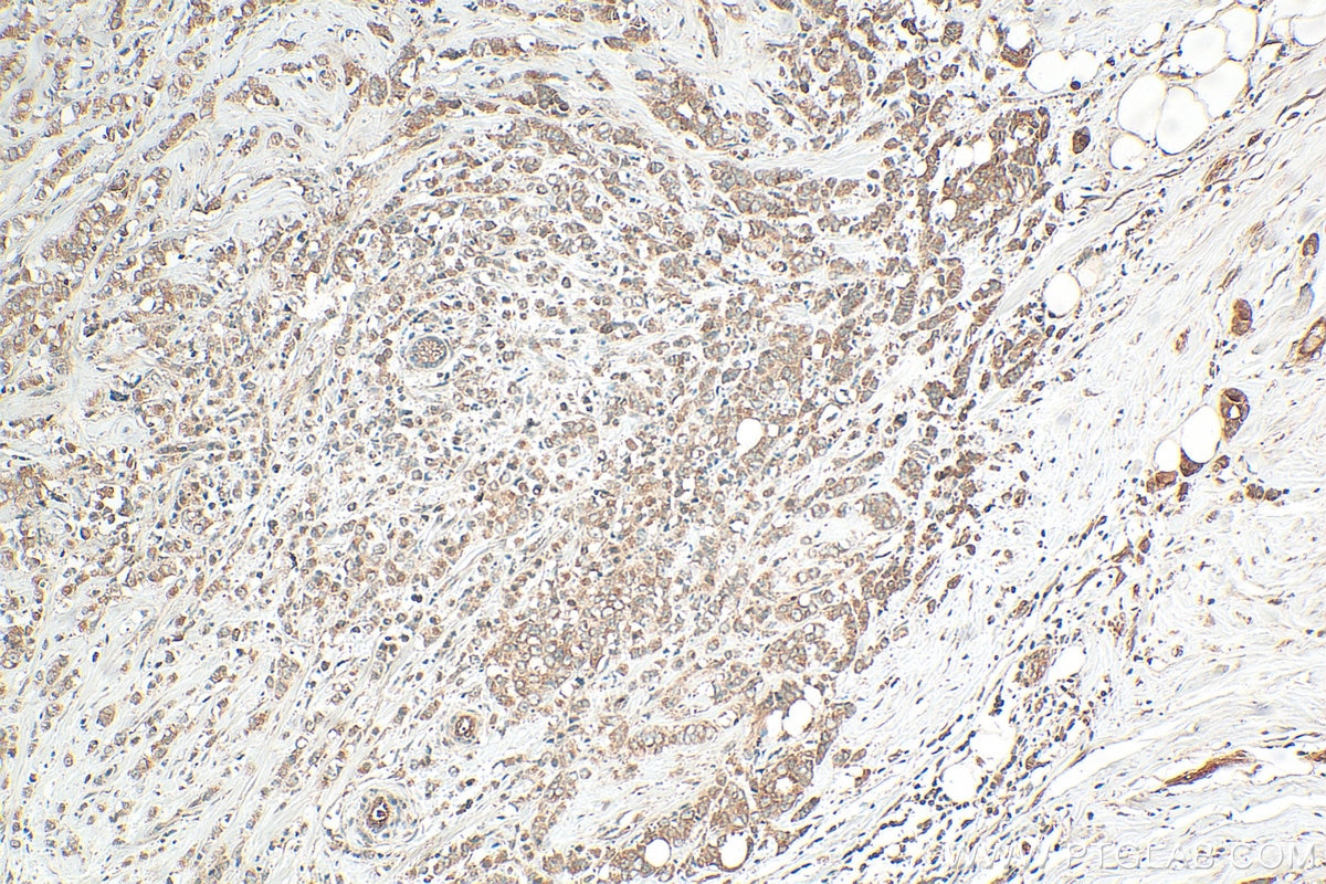 IHC staining of human breast cancer using 16948-1-AP Immunohistochemistry (IHC) staining of human breast cancer tissue using RNF11 Polyclonal antibody (16948-1-AP)