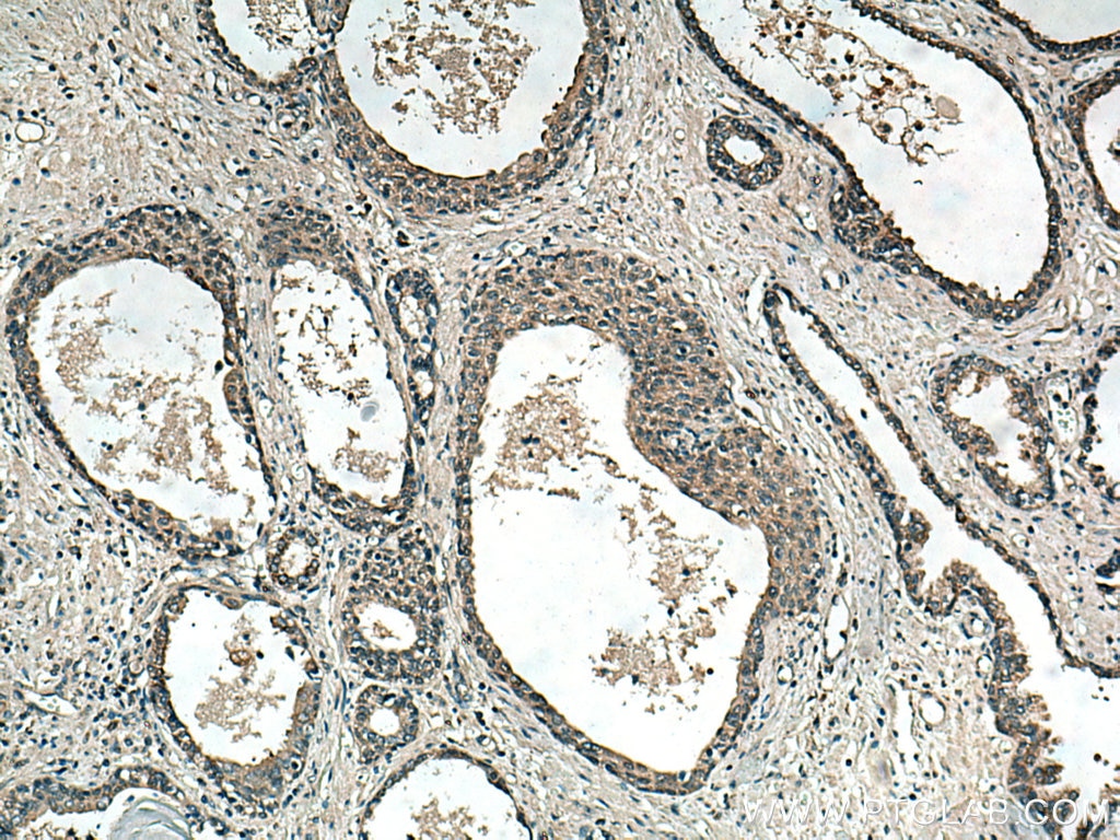 Immunohistochemistry (IHC) staining of human prostate cancer tissue using RNF113A Polyclonal antibody (27018-1-AP)