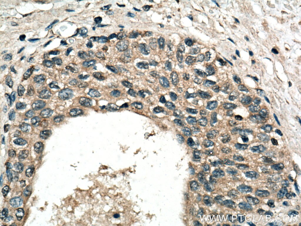 Immunohistochemistry (IHC) staining of human prostate cancer tissue using RNF113A Polyclonal antibody (27018-1-AP)