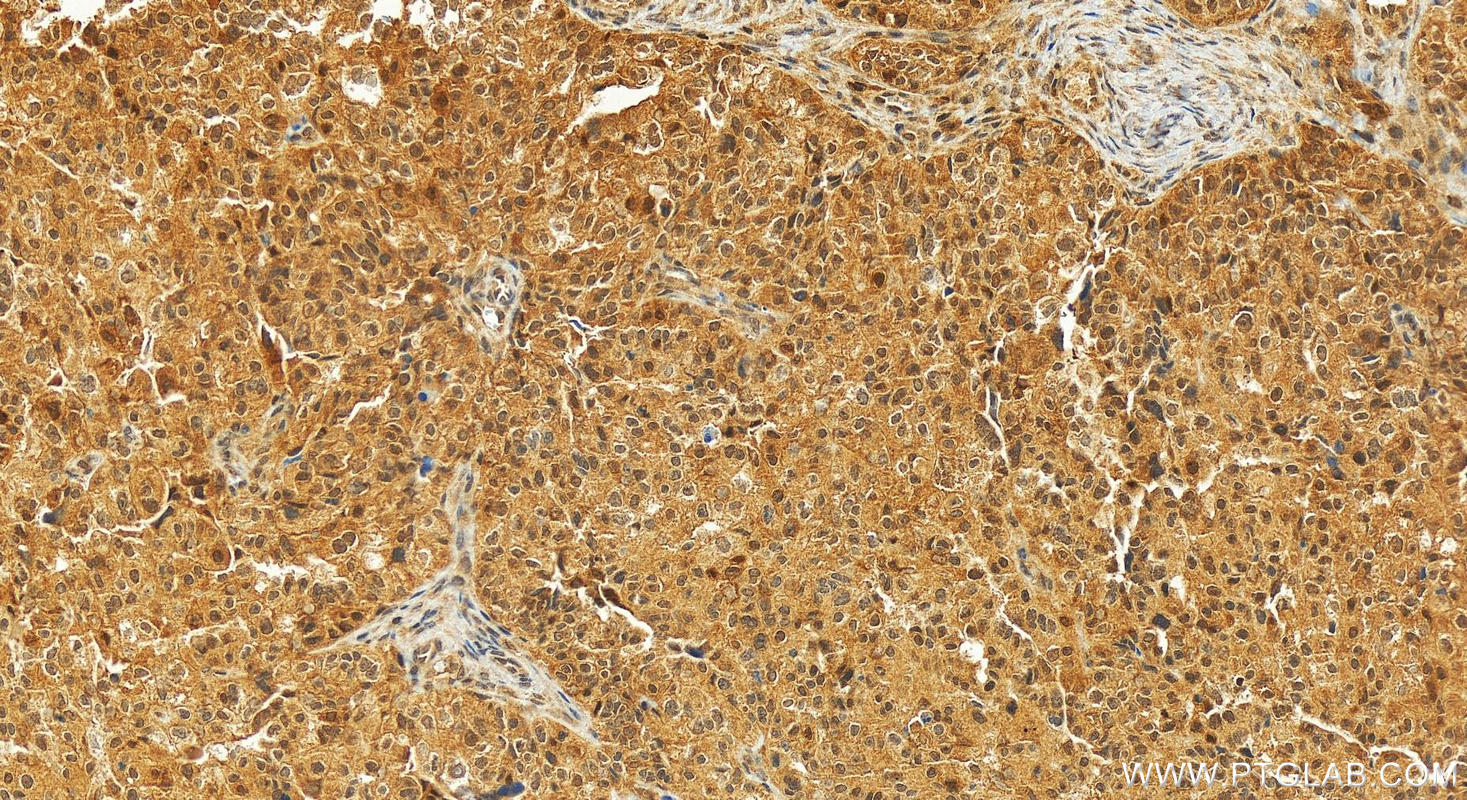 Immunohistochemistry (IHC) staining of human ovary cancer tissue using RNF114 Polyclonal antibody (14338-1-AP)