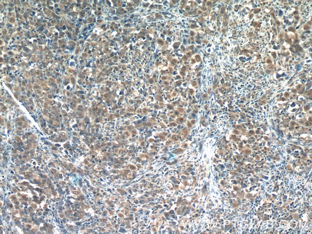 Immunohistochemistry (IHC) staining of human lymphoma tissue using RNF125 Polyclonal antibody (13290-1-AP)