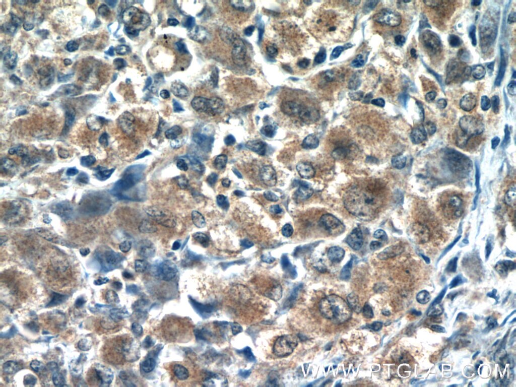 Immunohistochemistry (IHC) staining of human lymphoma tissue using RNF125 Polyclonal antibody (13290-1-AP)