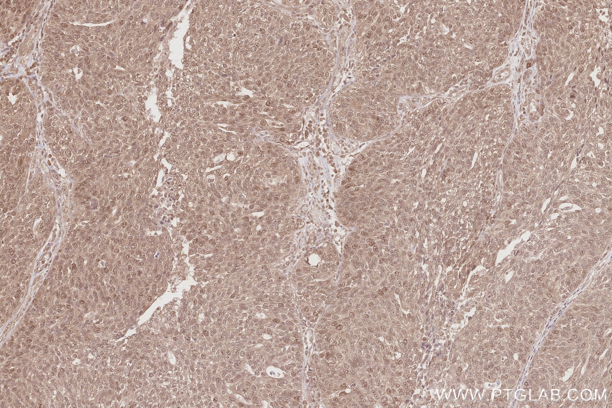 IHC staining of human ovary cancer using 19835-1-AP Immunohistochemistry (IHC) staining of human ovary cancer tissue using RNF126 Polyclonal antibody (19835-1-AP)