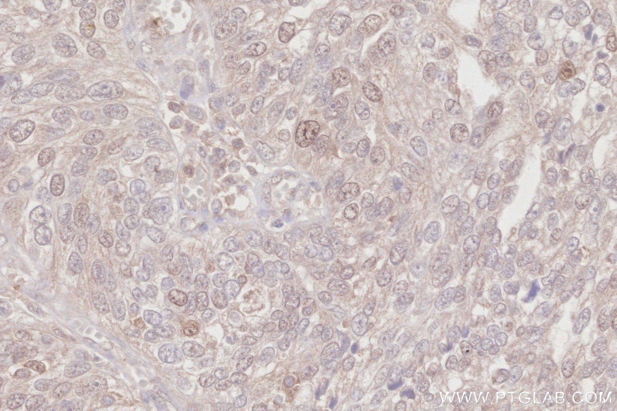 Immunohistochemistry (IHC) staining of human ovary cancer tissue using RNF126 Recombinant antibody (84772-6-RR)