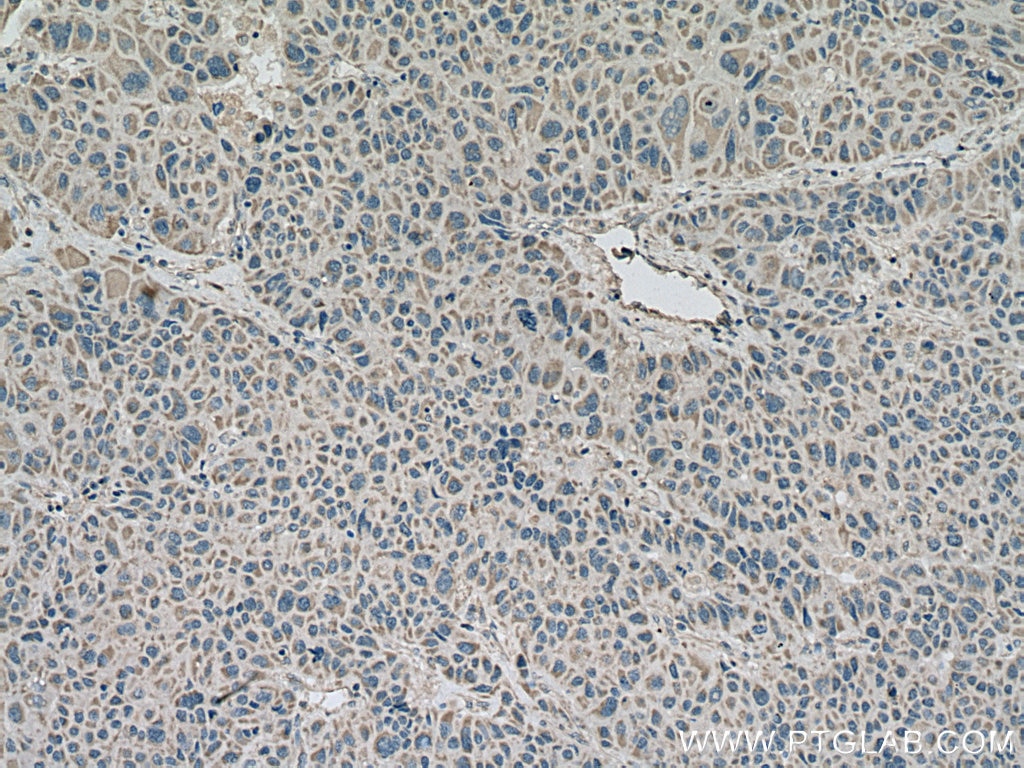 Immunohistochemistry (IHC) staining of human liver cancer tissue using RNF128 Polyclonal antibody (26015-1-AP)