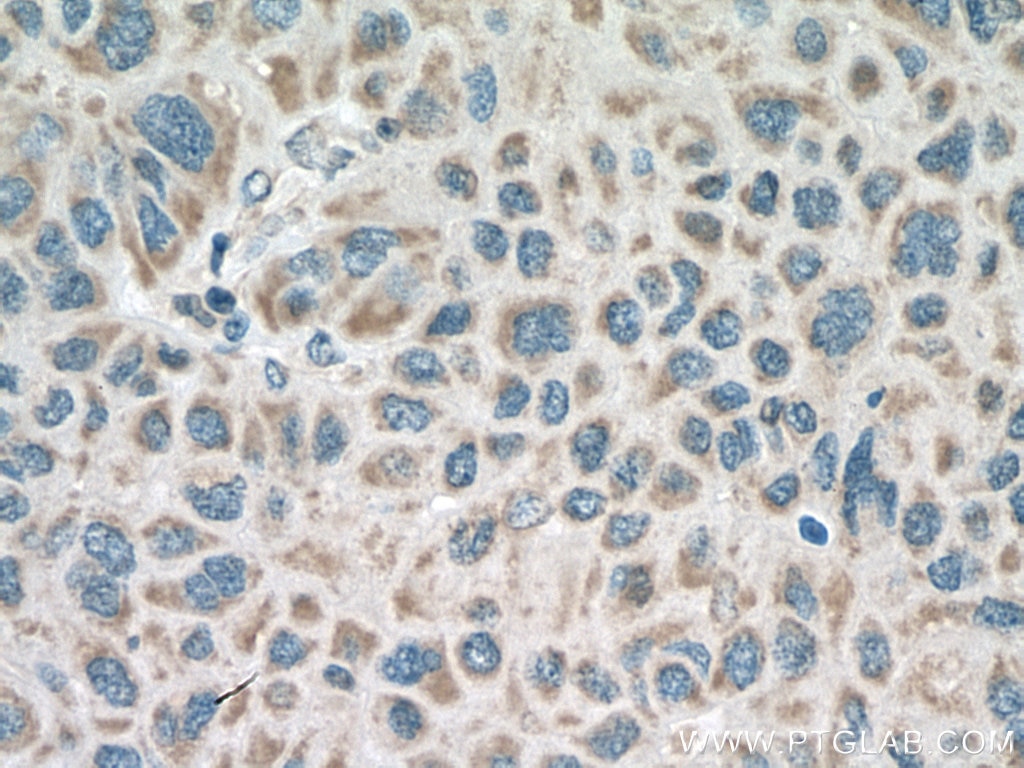 Immunohistochemistry (IHC) staining of human liver cancer tissue using RNF128 Polyclonal antibody (26015-1-AP)