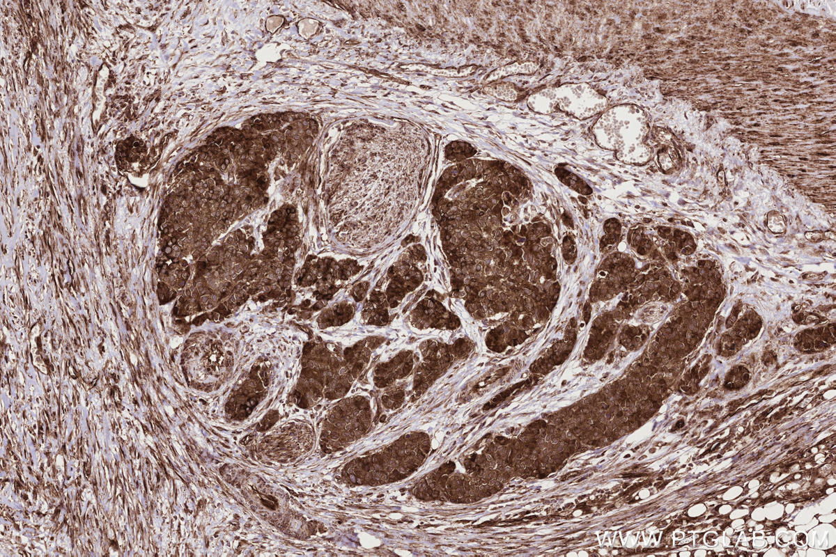 IHC staining of human stomach cancer using 83755-2-RR Immunohistochemistry (IHC) staining of human stomach cancer tissue using RNF139 Recombinant monoclonal antibody (83755-2-RR)
