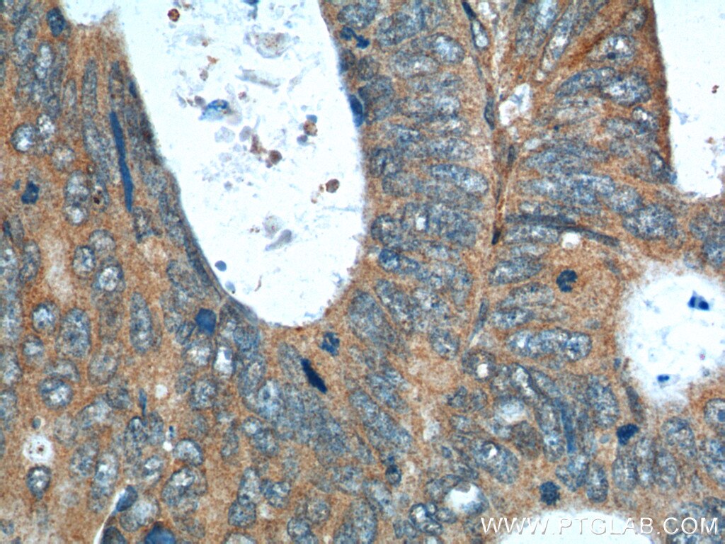 IHC staining of human colon cancer using 26368-1-AP