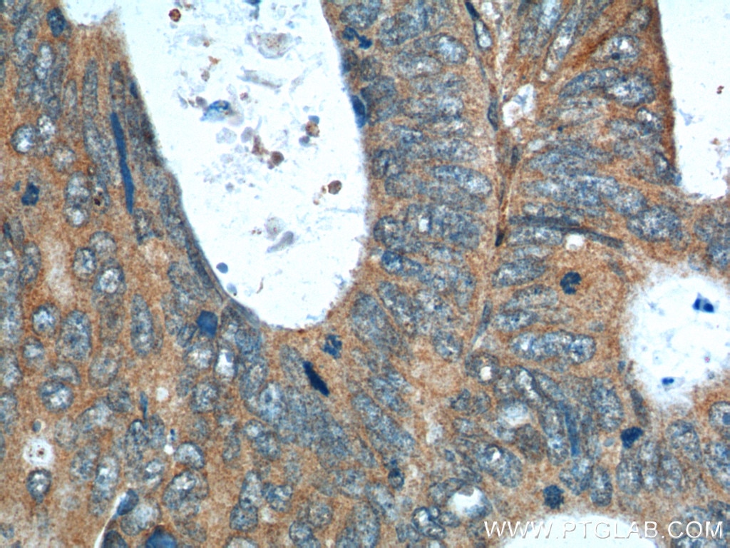 Immunohistochemistry (IHC) staining of human colon cancer tissue using RNF14 Polyclonal antibody (26368-1-AP)