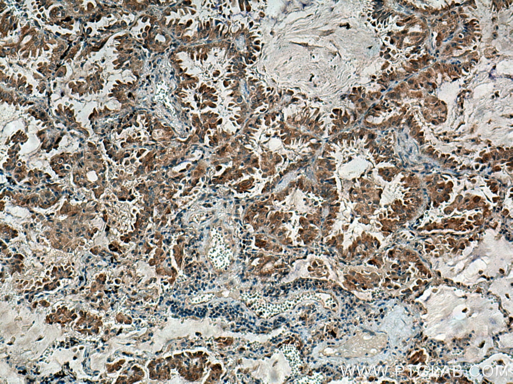 Immunohistochemistry (IHC) staining of human lung cancer tissue using RNF145 Polyclonal antibody (24524-1-AP)