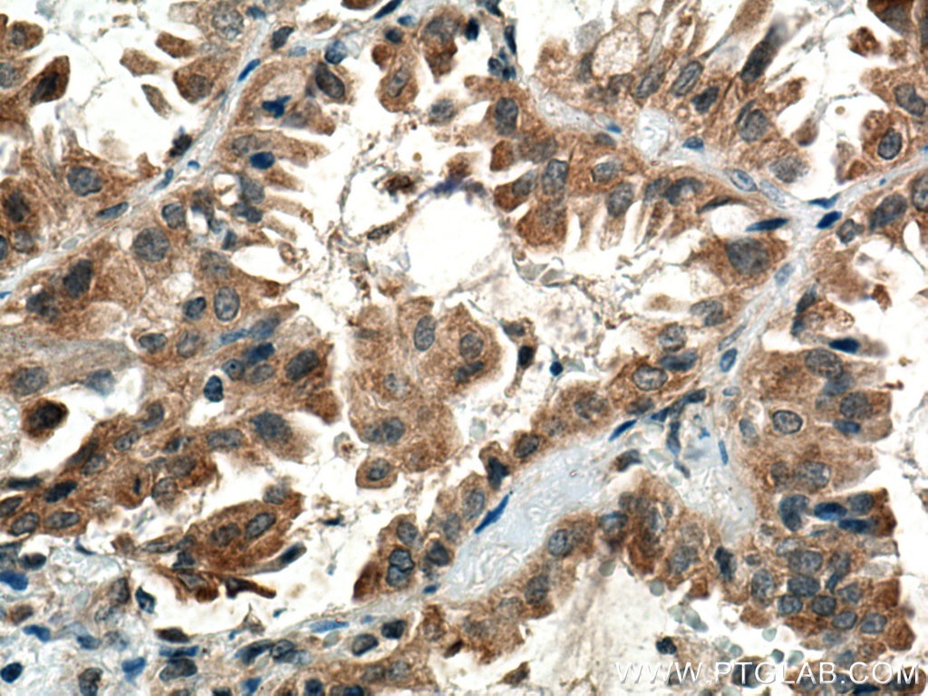 Immunohistochemistry (IHC) staining of human lung cancer tissue using RNF145 Polyclonal antibody (24524-1-AP)