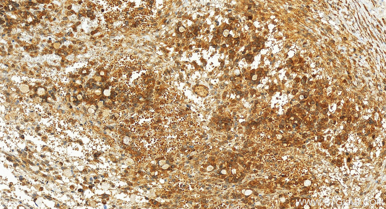 Immunohistochemistry (IHC) staining of human ovary cancer tissue using RNF146 Polyclonal antibody (23927-1-AP)
