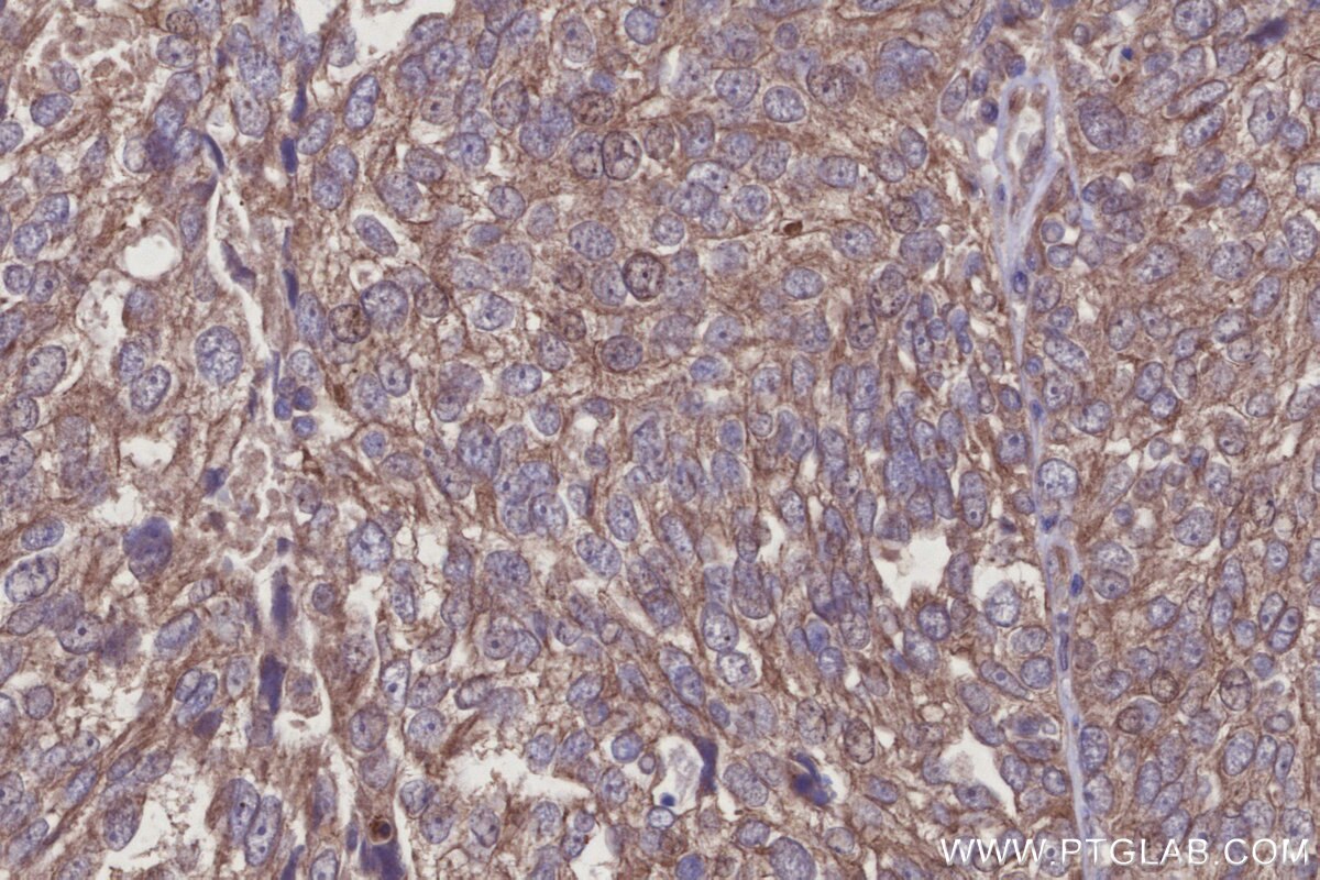 Immunohistochemistry (IHC) staining of human ovary cancer tissue using RNF167 Polyclonal antibody (24618-1-AP)