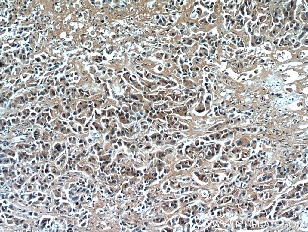 Immunohistochemistry (IHC) staining of human breast cancer tissue using RNF170 Polyclonal antibody (21024-1-AP)