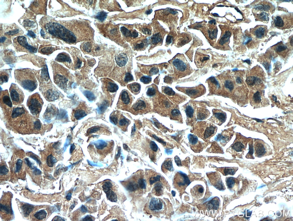 Immunohistochemistry (IHC) staining of human breast cancer tissue using RNF170 Polyclonal antibody (21024-1-AP)