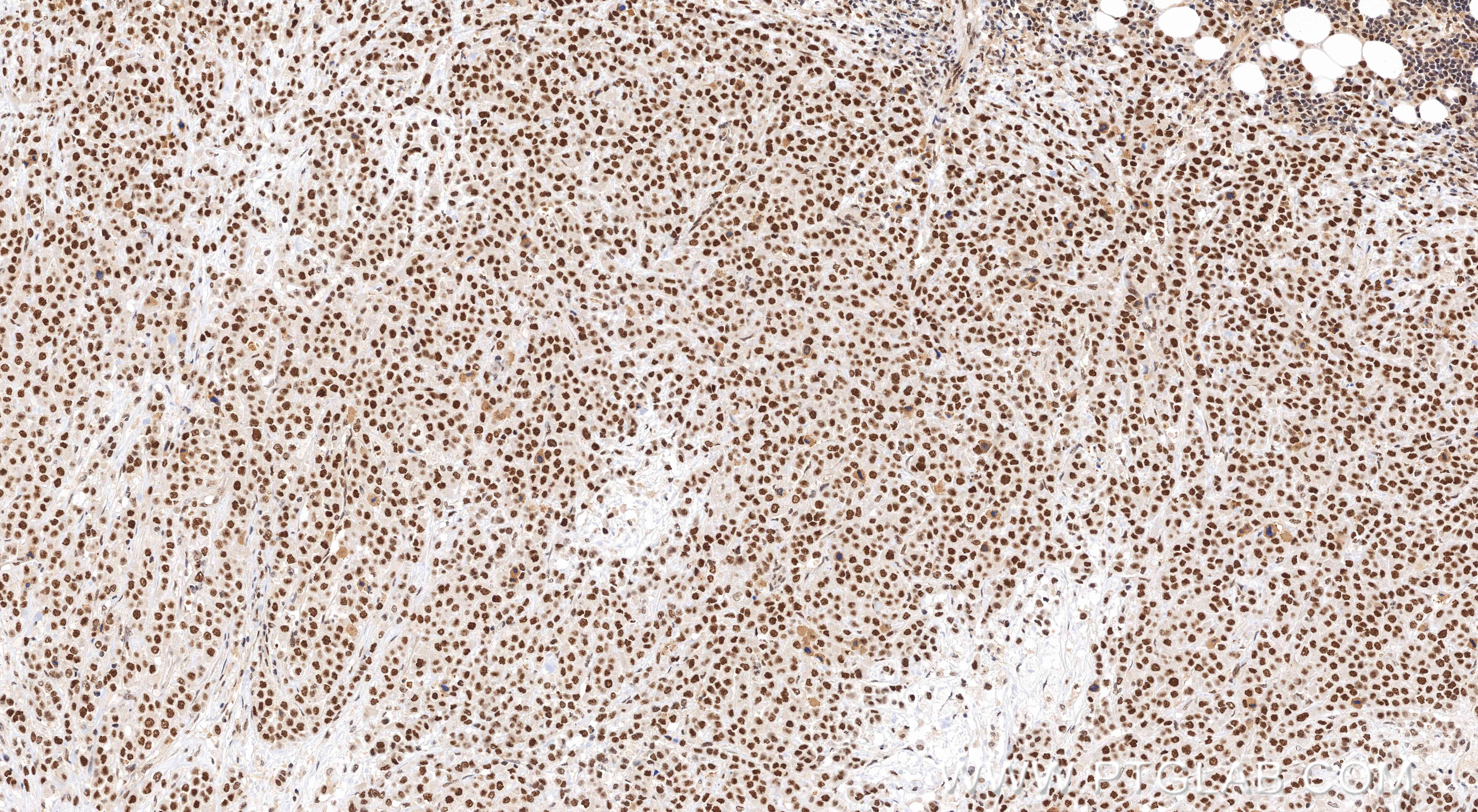 Immunohistochemical analysis of paraffin-embedded human breast cancer tissue slide using 85630-6-RR (RNF20 antibody) at dilution of 1:2000 (under 10x lens). Heat mediated antigen retrieval with Tris-EDTA buffer (pH 9.0). Immunohistochemistry (IHC) staining of human breast cancer tissue using RNF20 Recombinant monoclonal antibody (85630-6-RR)