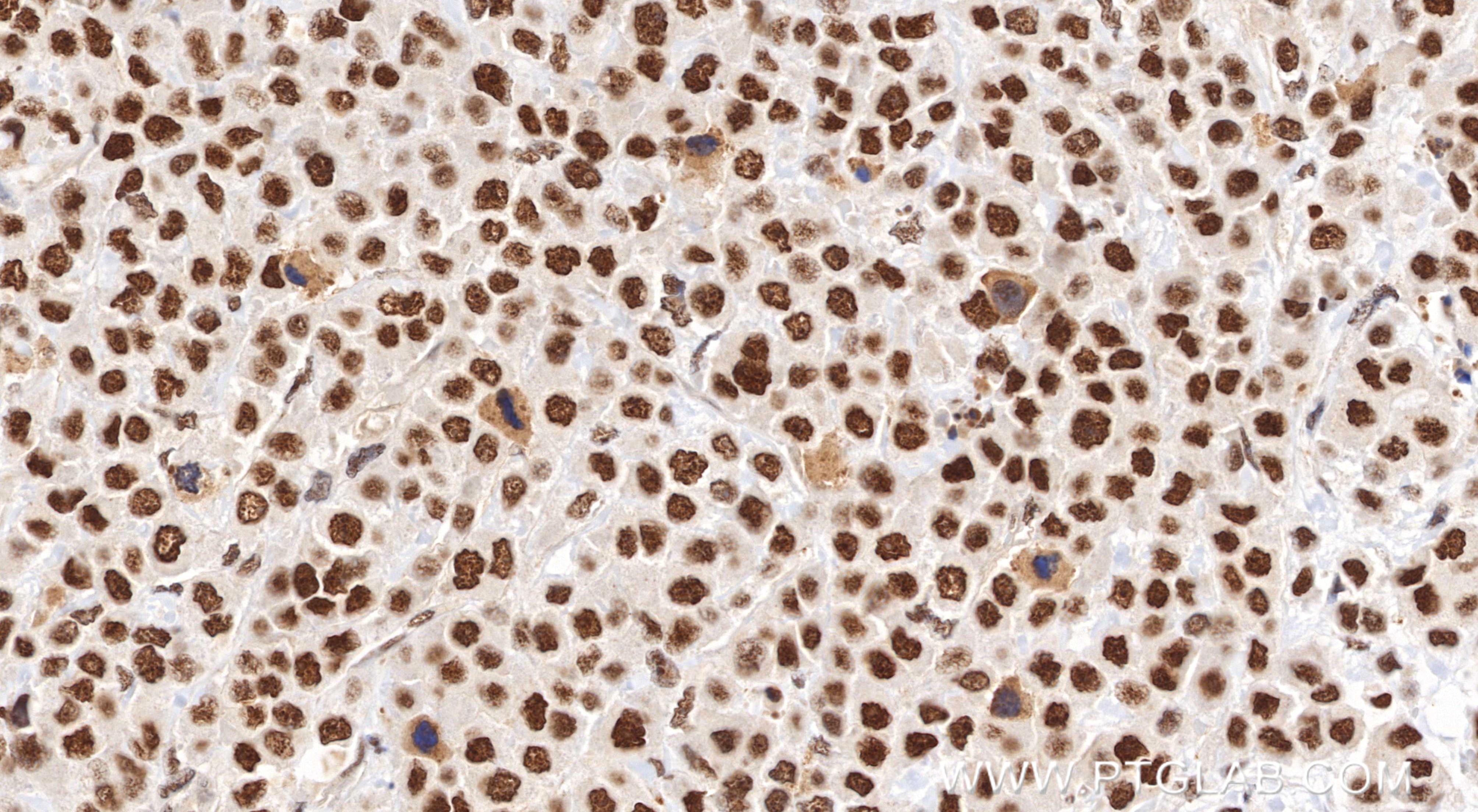 Immunohistochemical analysis of paraffin-embedded human breast cancer tissue slide using 85630-6-RR (RNF20 antibody) at dilution of 1:2000 (under 40x lens). Heat mediated antigen retrieval with Tris-EDTA buffer (pH 9.0). Immunohistochemistry (IHC) staining of human breast cancer tissue using RNF20 Recombinant monoclonal antibody (85630-6-RR)
