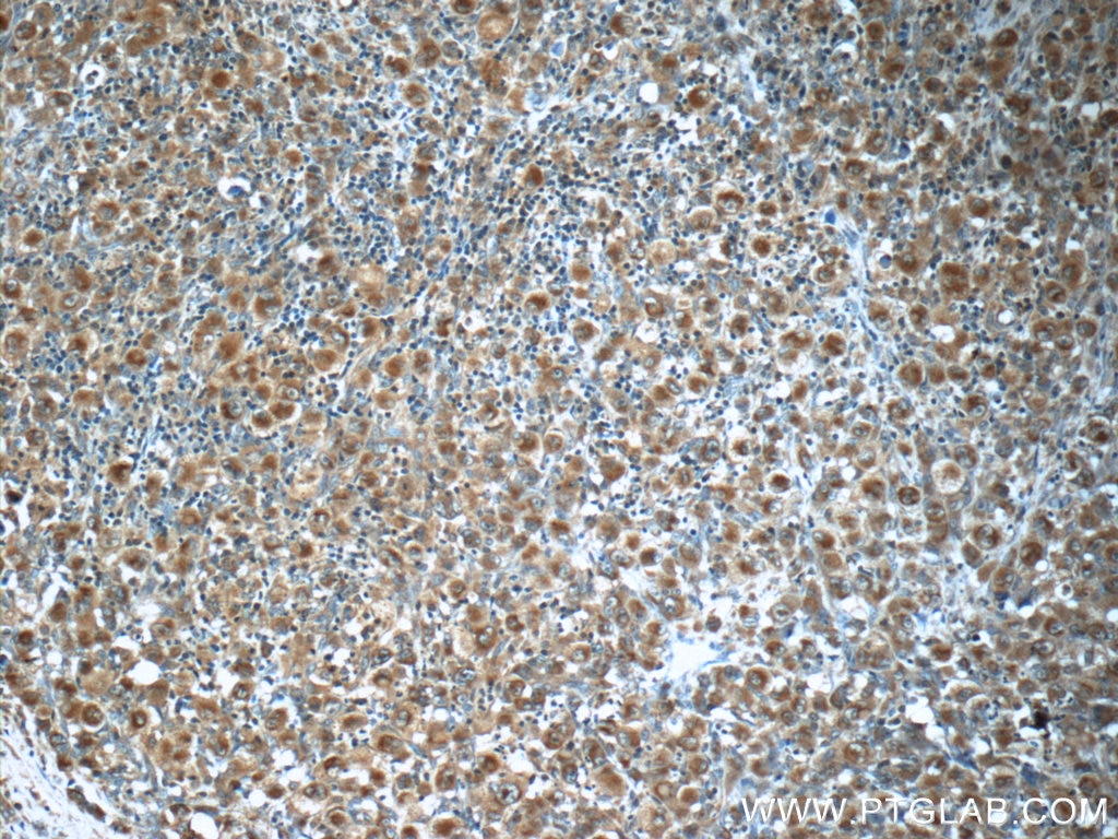 Immunohistochemistry (IHC) staining of human lymphoma tissue using RNF213 Polyclonal antibody (21028-1-AP)