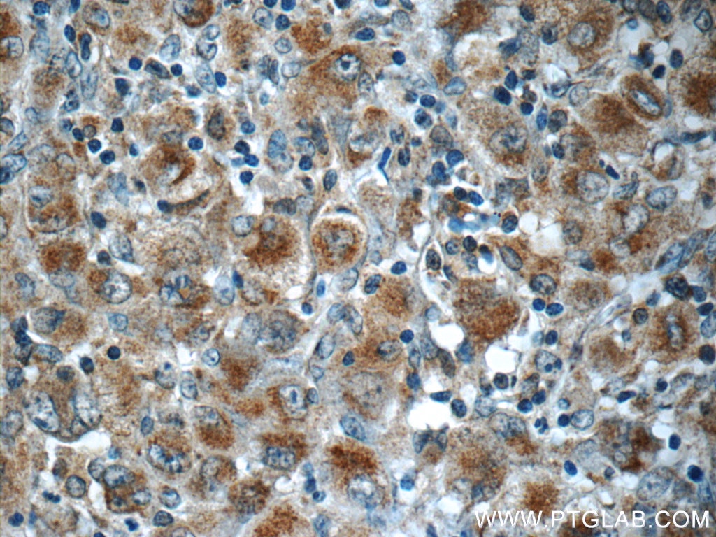 Immunohistochemistry (IHC) staining of human lymphoma tissue using RNF213 Polyclonal antibody (21028-1-AP)