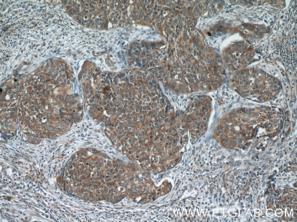 Immunohistochemistry (IHC) staining of human cervical cancer tissue using RNF25 Polyclonal antibody (24536-1-AP)