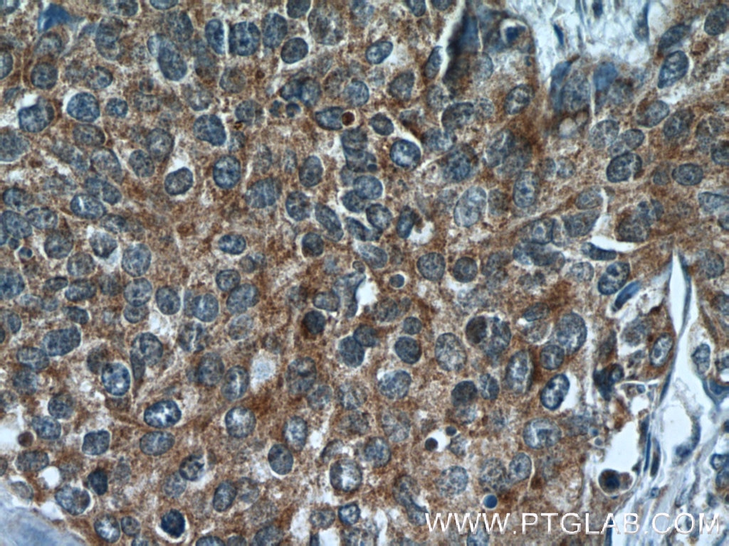Immunohistochemistry (IHC) staining of human cervical cancer tissue using RNF25 Polyclonal antibody (24536-1-AP)