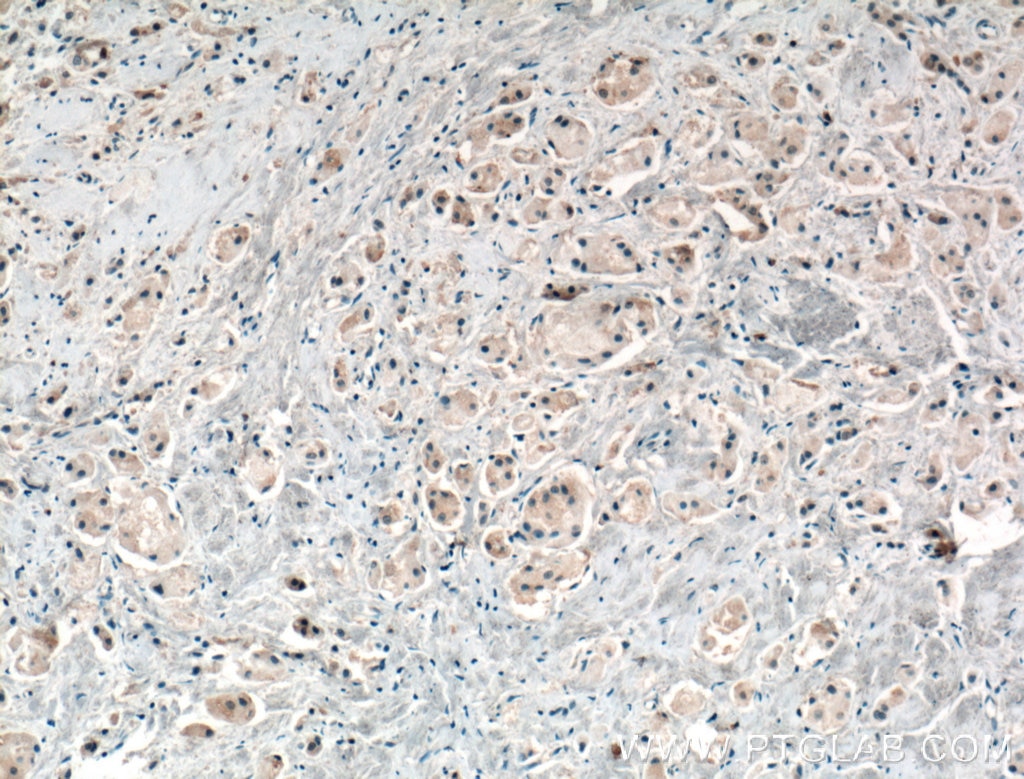 Immunohistochemistry (IHC) staining of human breast cancer tissue using HOIP Polyclonal antibody (16289-1-AP)