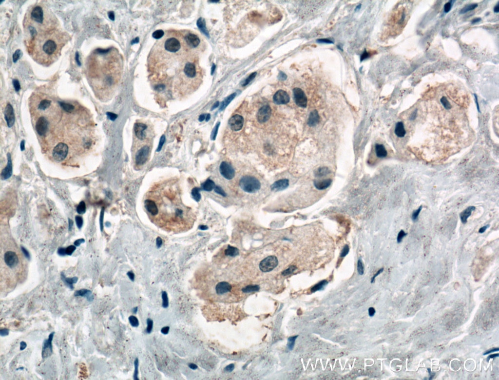 Immunohistochemistry (IHC) staining of human breast cancer tissue using HOIP Polyclonal antibody (16289-1-AP)